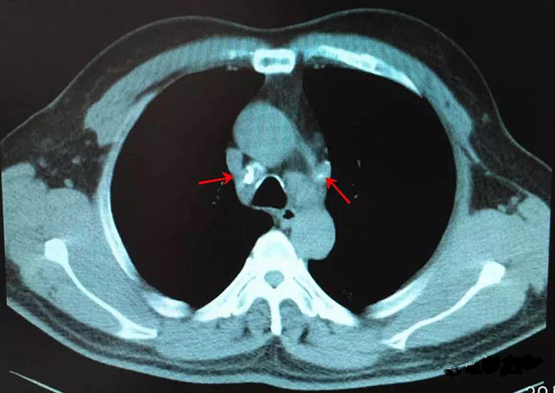 一起来看ct片(28)——纵隔淋巴结钙化