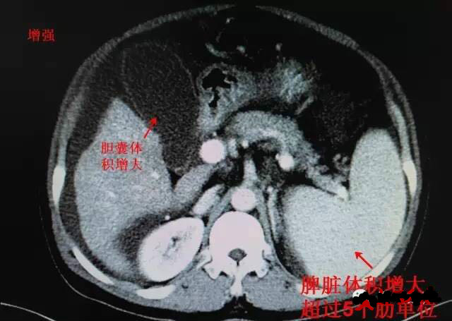 一起来看ct片(1)——肝硬化并腹水