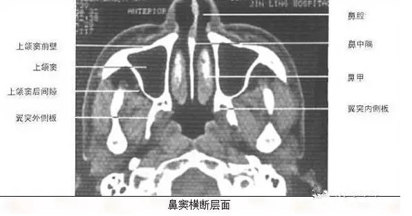 渔歌医疗|一起来看CT片(20)--鼻窦炎