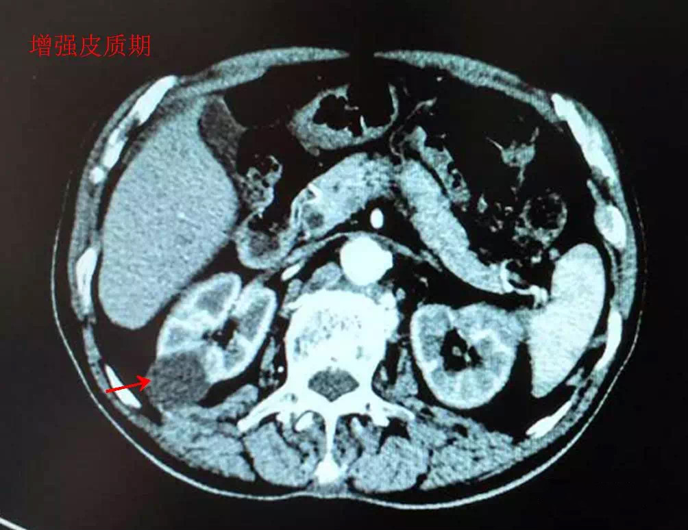 一起来看ct片(4)——肾囊肿