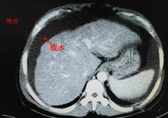 一起来看ct片(1)——肝硬化并腹水