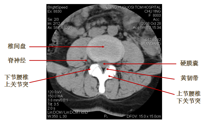 一起来看ct片——椎间盘膨出与突出