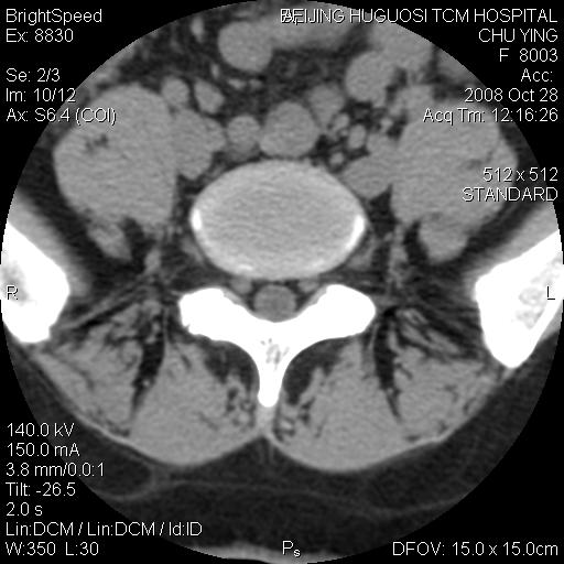 渔歌医疗|一起来看CT片(8)--椎间盘膨出与突出