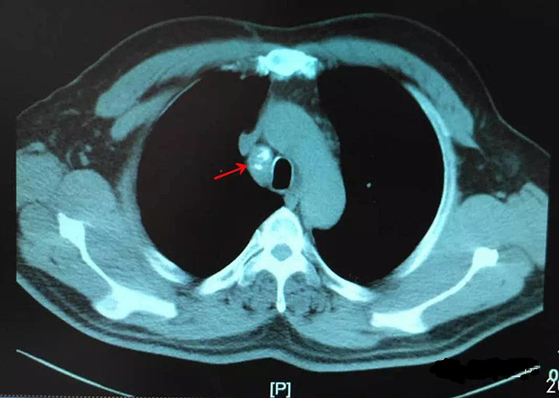 一起来看ct片(28)——纵隔淋巴结钙化