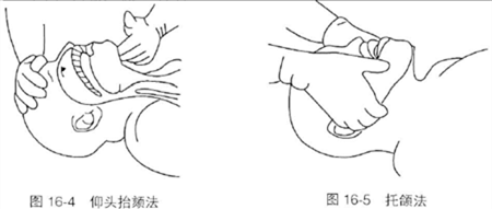 防止因舌根后坠阻塞呼吸道,可采用仰头举颏法,仰头抬颈法(对有颈椎