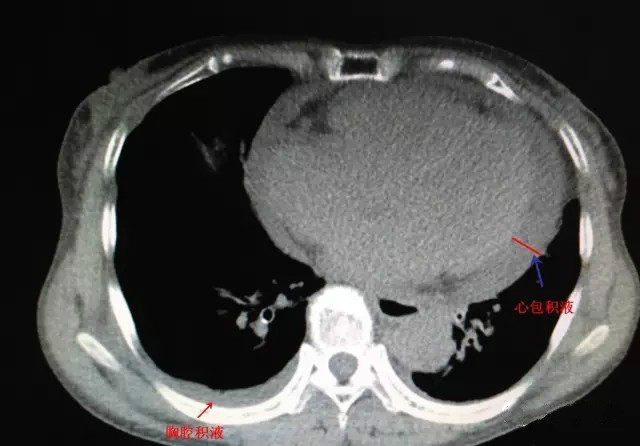 心包积液主要ct影像特点