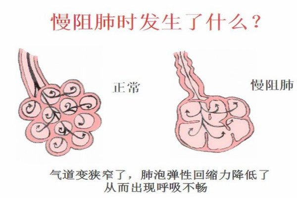 家庭护理必修课——慢性阻塞性肺病的护理措施